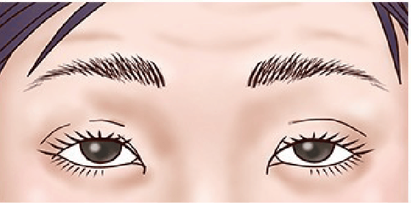 二重修正術 前の目元イラスト